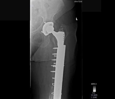 Periprosthetic Fracture Classification