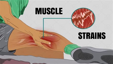 Dr. Naval Parikh: Sprain and Muscle Strain Treatment & Guide - Naval Parikh