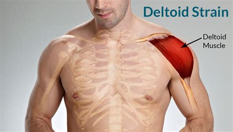 Deltoid Strain: Treatment, Causes, Symptoms, Classification