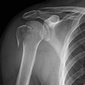 Proximal Humerus Fractures - Trauma - Orthobullets