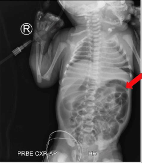 A Case Report of Hirschsprung’s Disease in a Neonate: Early Detection and Review of Management ...