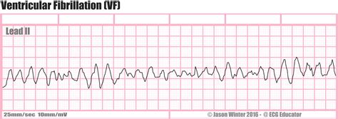 ECG Educator Blog : Ventricular Fibrillation (VF)