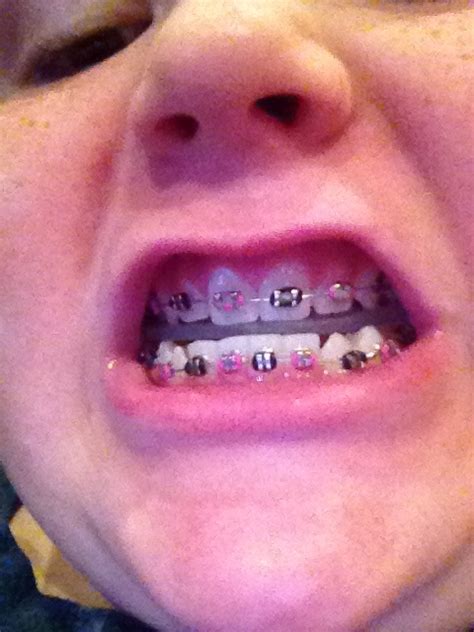 diy fake braces for halloween - Very Simple Choice Podcast Pictures Gallery