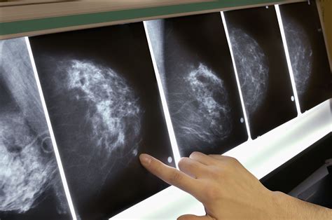 Important Facts About Breast Cancer Tumors