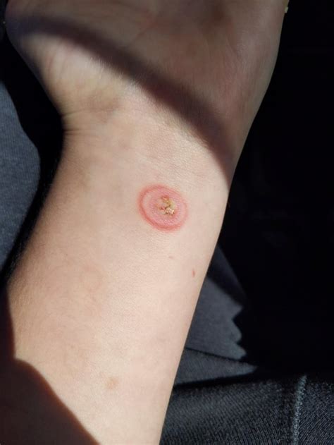 infected? it was a 2nd degree burn from a lighter, and blister popped accidentally when loading ...