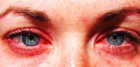 allergic conjunctivitis | Royal Oak Eye Care