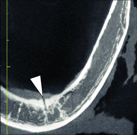 Lingual foramen (arrowhead). | Download Scientific Diagram