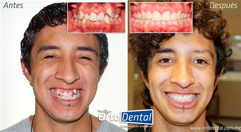 Increíbles Cambios Faciales con Ortodoncia | OrtoDental | Ortodoncista ...