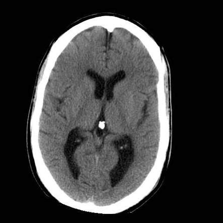 Intraventricular hemorrhage (tiny) | Radiology Case | Radiopaedia.org