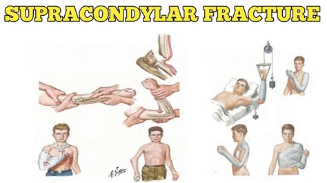 Supracondylar Fracture: Understanding the Injury and Effective ...