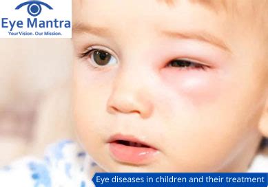 Children’s Eye Diseases- Common Pediatric Eye Problems