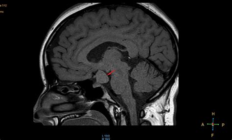 Cureus | Secondary Amenorrhea Revealing a Giant Hamartoma of the Tuber Cinereum