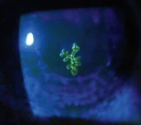 Herpes simplex dendritic ulcer. Fluorescein staining of the cornea that was viewed under ...