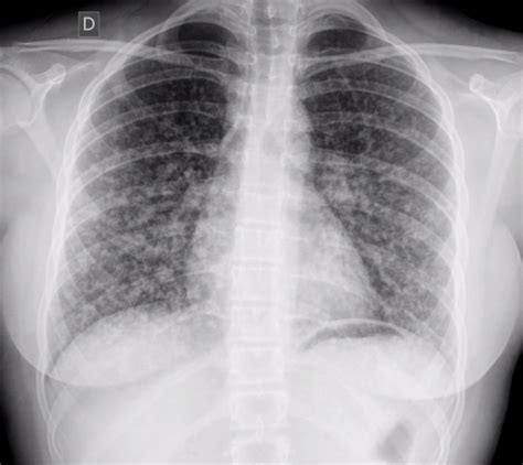 Papillary thyroid cancer chest x ray - wikidoc