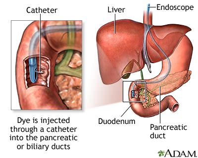 ERCP Information | Mount Sinai - New York