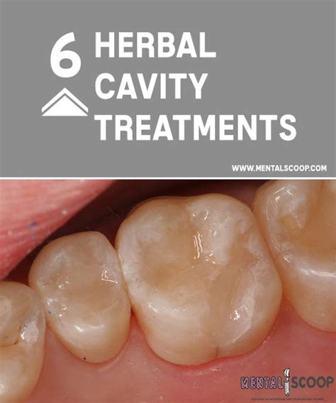 6 Herbal Cavity Treatments - Mental Scoop