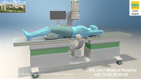 Lithotripsy Procedure