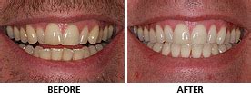 Inman Aligner before and after pictures - Inman Aligner