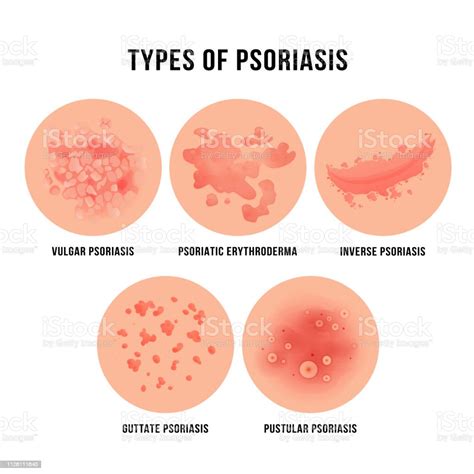 Psoriasis Skin Disease Types Of Derma Problem Stock Illustration ...