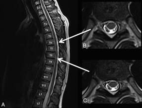 Improved Lesion Detection by Using Axial T2-Weighted MRI with Full Spinal Cord Coverage in ...