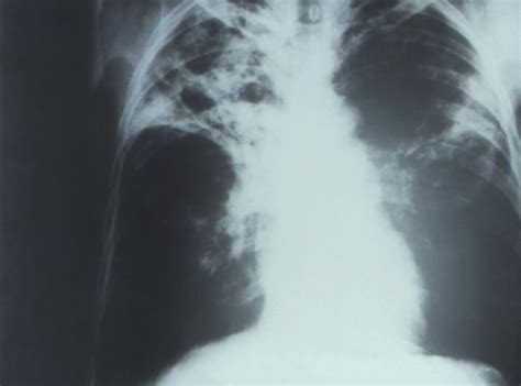 Tuberculosis chest x ray - wikidoc