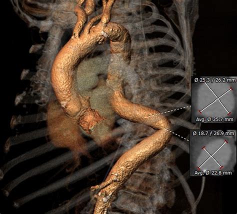 Thoracic Aorta