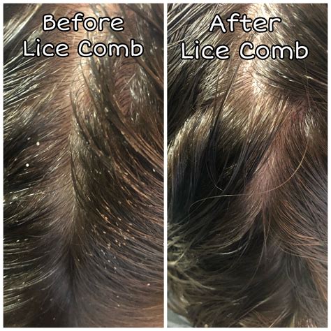 Terminator Lice Comb – The Louse Girl Mobile Head Lice Removal Service