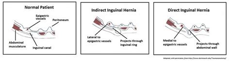 inguinal hernias Abdominal, Vessel, Directions, Projects, Uni, Field ...