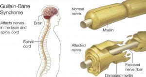 Guillain-Barré Syndrome(GBS): Causes, Symptoms, Diagnosis & Treatment ...