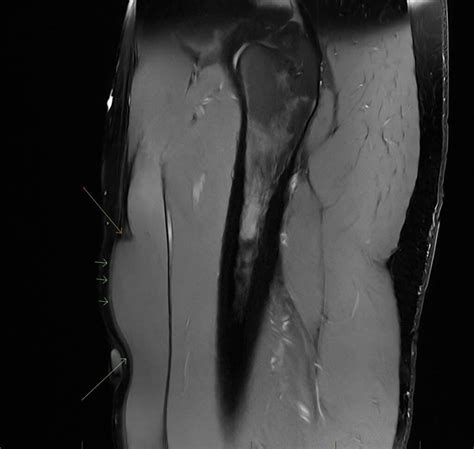 IMAGING GUIDED EUFLEXXA INJECTION FOR MANAGEMENT OF KNEE OSTEOARTHRITIS ...