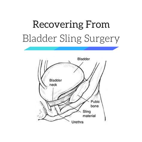 Bladder Sling Surgery Recovery After TOT, TVT, Bone-Anchored Procedures