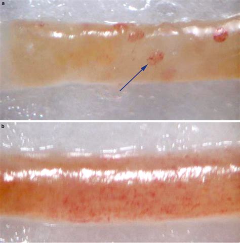 Renal biopsy specimen as seen with a dissecting microscope. (a) Renal ...