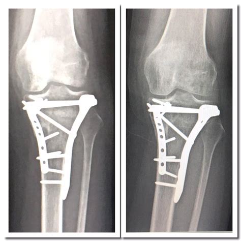 Tibial Plateau Fracture Recovery Part Four: Learning to Walk Again - The Kitchen Prescription