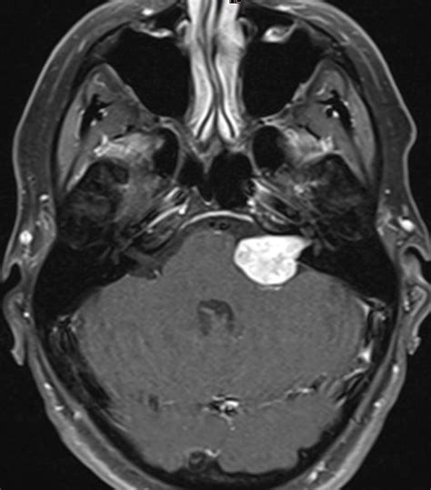 Acoustic Neuroma as related to Hearing Loss - Pictures