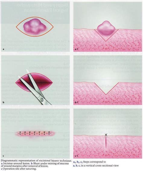 What is a Biopsy? – Exodontia