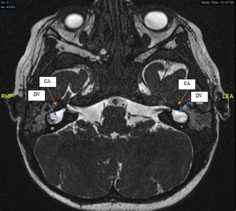 Audiological and Speech Performance After Cochlear Implantation in Cochlear Aplasia Deformity ...