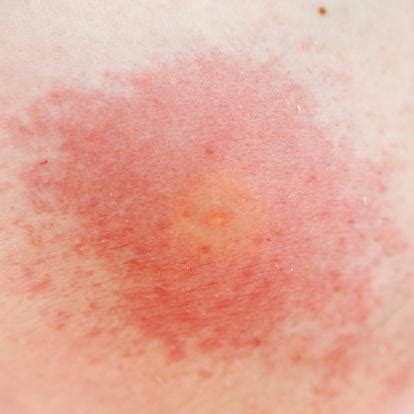 bee sting allergy - pictures, photos