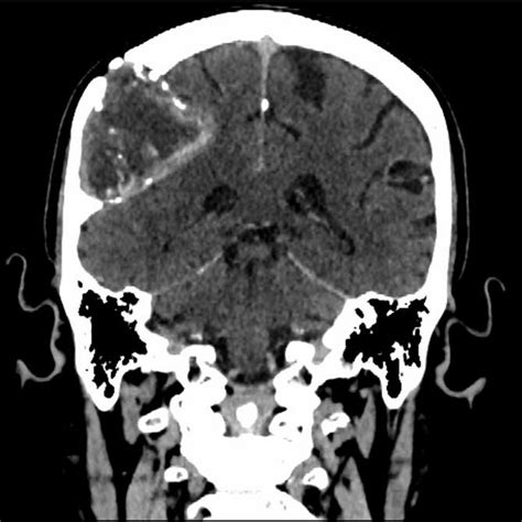 Sagittal CT scan showing the extra-axial lesion with surrounding bone ...