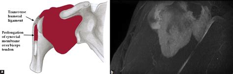 Subdeltoid Bursitis Mri