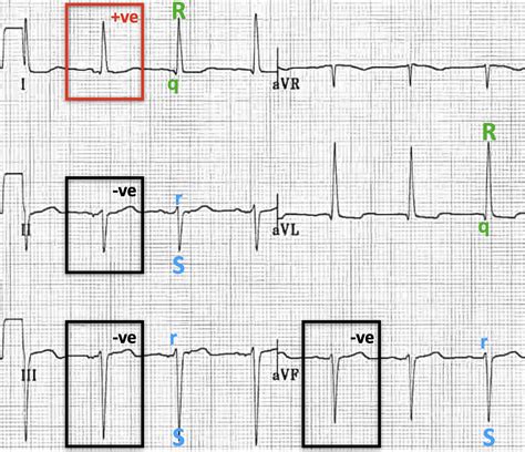 Left Anterior Fascicular Block (LAFB) • LITFL • ECG Library Diagnosis