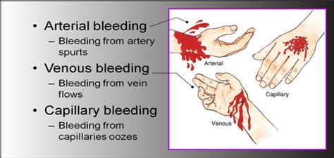 Capillary Wounds - Venous Wounds - Arterial Wounds - Nate C. and Tyler B. and Dani H. First Aid ...