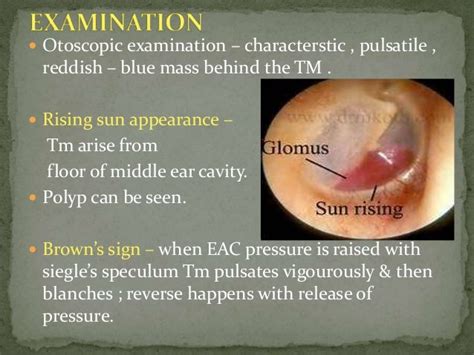 Glomus Tumor Ear