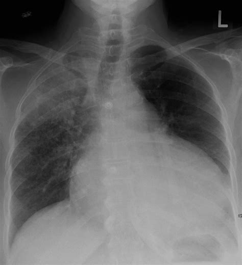 The Pericardium - TeachMeAnatomy