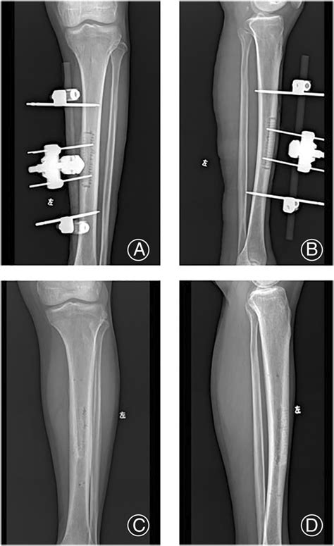 Tibial osteotomy. (A, B) Tibial osteotomy is moved laterally; (C, D ...