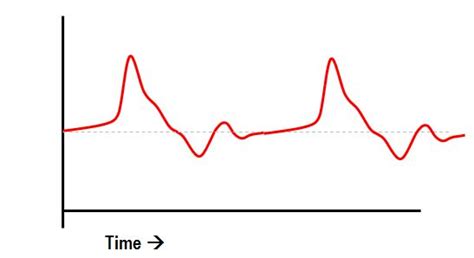 Abnormal central venous pressure waveform patterns | Deranged Physiology