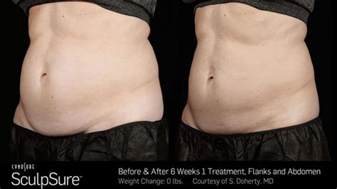 SculpSure before and after Photos: Real Patient Results - New Beauty ...