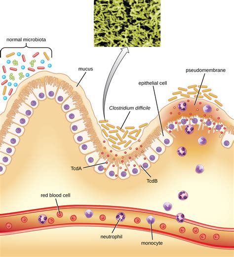 24.3: Infecciones Bacterianas del Tracto Gastrointestinal - LibreTexts ...