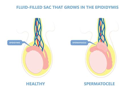 Spermatocele: Symptoms, Causes, and Treatments | Birla Fertility & IVF