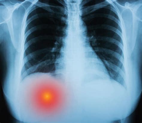 What Causes Pain Under Right Rib Cage?