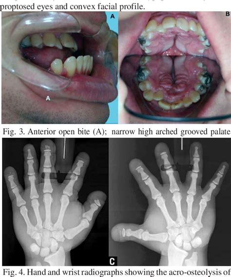 Figure 3 from Morphological Features of Pycnodysostosis with Emphasis ...